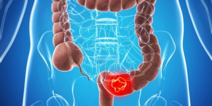 Kolon (Barsak) Kanseri Hakkında